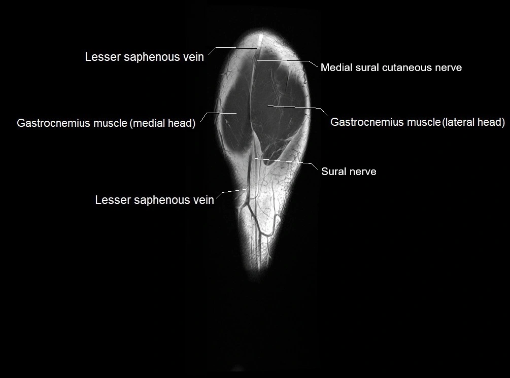 MRI 3T leg (tibia & fibula) labelled coronal cross sectional anatomy image 28.webp